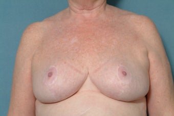 Age: 55, Height: 5"8" Weight: 195lbs. after 689932