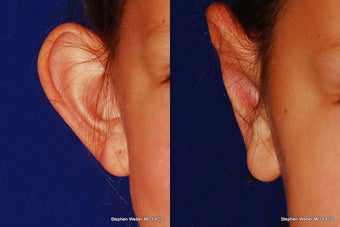 Ear Surgery before 1445762
