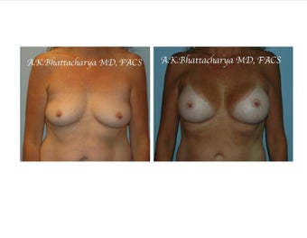 48 year old woman treated with Breast Augmentation before 3102870