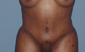 Tummy tuck (abdominoplasty) redo (secondary) after 845767