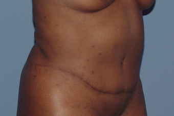 Tummy tuck (abdominoplasty) redo (secondary) 845767