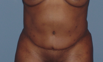 Tummy tuck (abdominoplasty) redo (secondary) before 845767