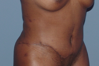 Tummy tuck (abdominoplasty) redo (secondary) 845767