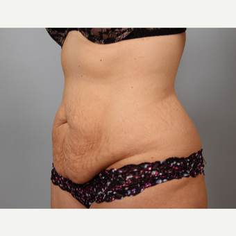 28 year old after childbearing and weight loss had abdominoplasty before 3288395