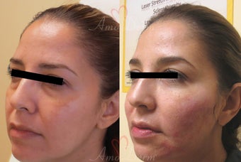 35-44 year old woman treated with Restylane before 3670647