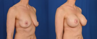 35-44 year old woman treated with Breast Lift with Implants after 3538128