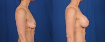 35-44 year old woman treated with Breast Lift with Implants 3538128