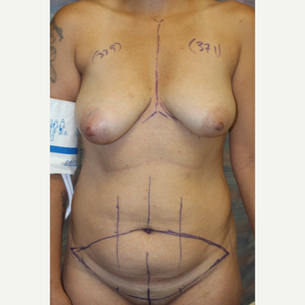 25-34 year old woman treated with Mommy Makeover before 3321825