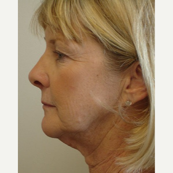 55-64 year old woman treated with Facelift before 3266344