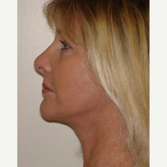 55-64 year old woman treated with Facelift after 3266344