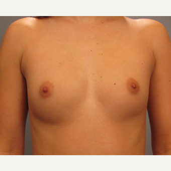 25-34 year old woman treated with Endo-Axillary Breast Augmentation before 3423883