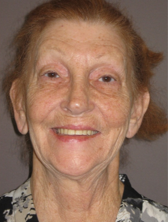65-74 year old woman treated with Facelift, Upper/Lower Eyelids, Fat Injection, Fractional Laser before 1975061