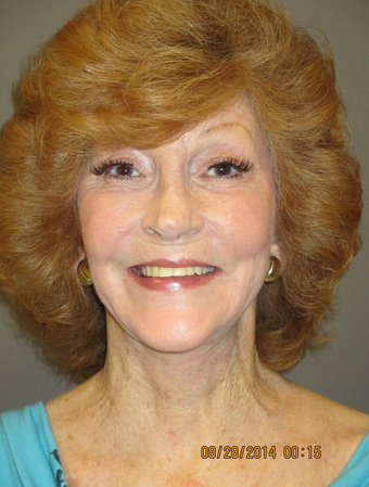 65-74 year old woman treated with Facelift, Upper/Lower Eyelids, Fat Injection, Fractional Laser after 1975061
