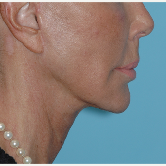 62 year old woman underwent revision facelift after 3730798