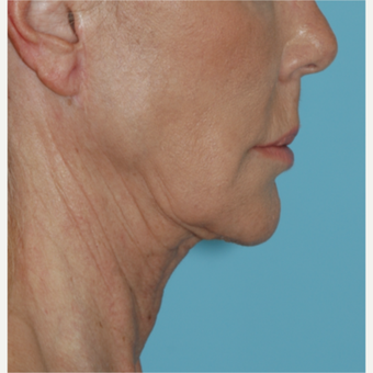 62 year old woman underwent revision facelift before 3730798