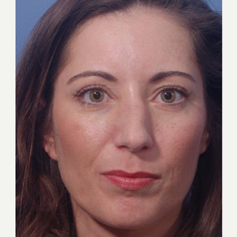 35-44 year old woman treated with Rhinoplasty before 3711565