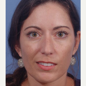 35-44 year old woman treated with Rhinoplasty after 3711565