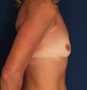 45 Year Old Female with Silicone Breast Augmentation 1428541