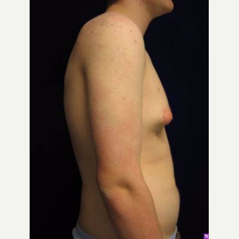 25-34 year old man treated with Male Breast Reduction before 3711763