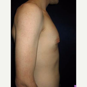 25-34 year old man treated with Male Breast Reduction after 3711763
