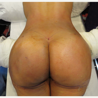 25-34 year old woman treated with Brazilian Butt Lift after 3446895