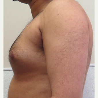 Male Breast Reduction for this 32 Year Old Man before 2997892