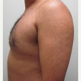 Male Breast Reduction for this 32 Year Old Man after 2997892