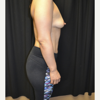 35-44 year old woman treated with Breast Augmentation before 3763780