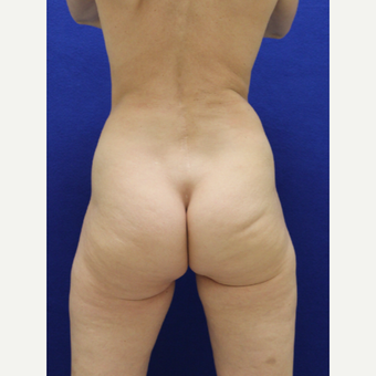 35-44 year old woman treated with Brazilian Butt Lift before 3482335