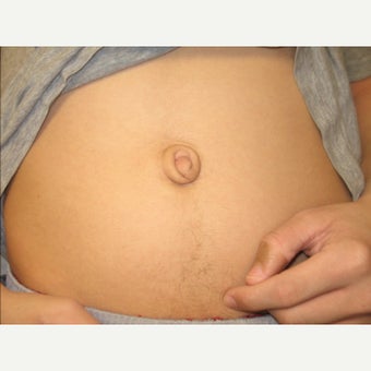 18-24 year old man treated with Belly Button Surgery before 1671135