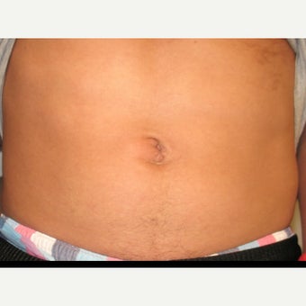 18-24 year old man treated with Belly Button Surgery after 1671135