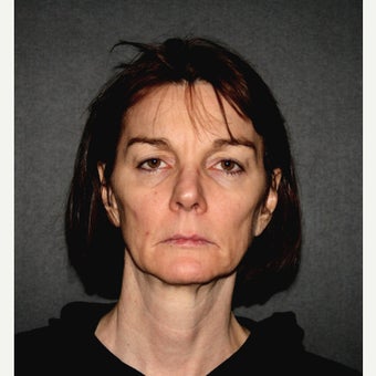 55-64 year old woman treated with Mini Lift before 1885686