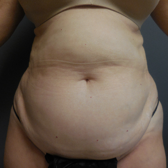 65-74 year old woman treated with Tummy Tuck before 3788580