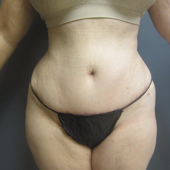 65-74 year old woman treated with Tummy Tuck after 3788580