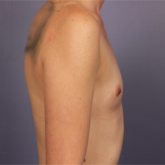 Breast implants before 3646877