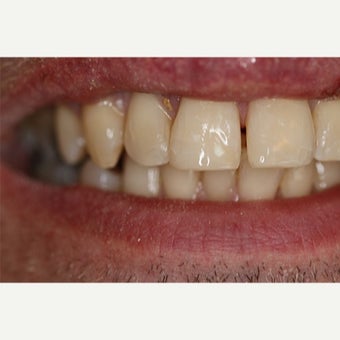 35-44 year old man treated with Dental Bonding after 2651248