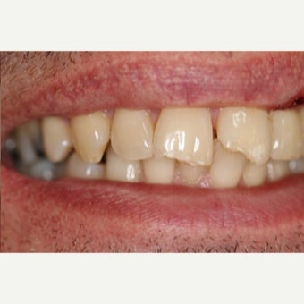 35-44 year old man treated with Dental Bonding before 2651248