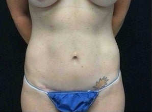 35-44 year old woman treated with Tummy Tuck after 3219180