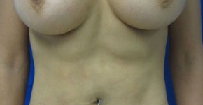 Liposuction after 3094213