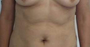 Liposuction before 3094213
