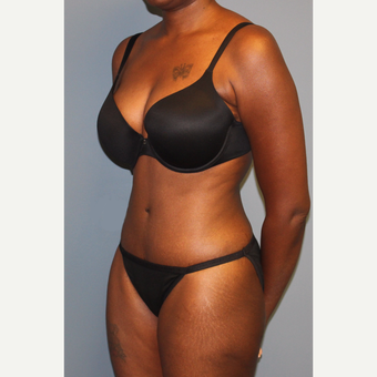 25-34 year old woman treated with Tummy Tuck after 3558415