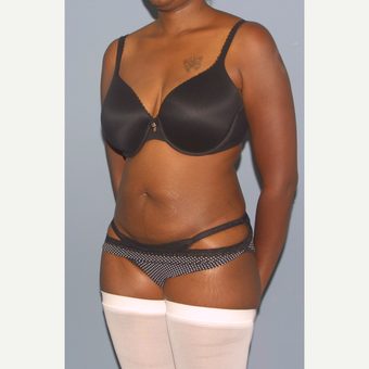 25-34 year old woman treated with Tummy Tuck before 3558415