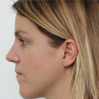 35-44 year old woman treated with Septoplasty after 3605557