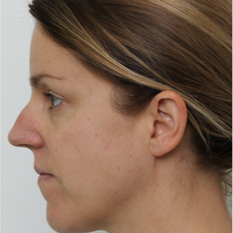 35-44 year old woman treated with Septoplasty before 3605557
