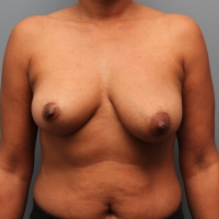 46 year old woman had breast augmentation with the Ideal Implant before 3390724