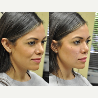 25-34 year old woman treated with Restylane before 3181987