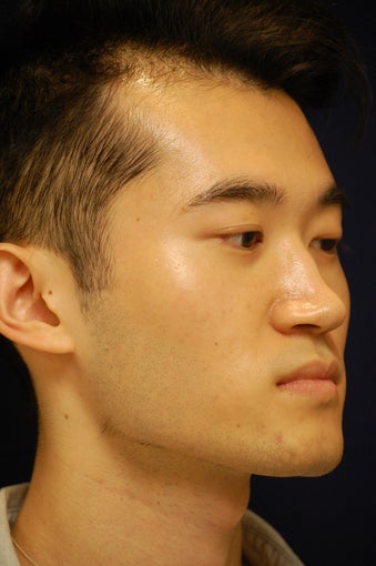 18-24 year old man treated with Rhinoplasty 3688881