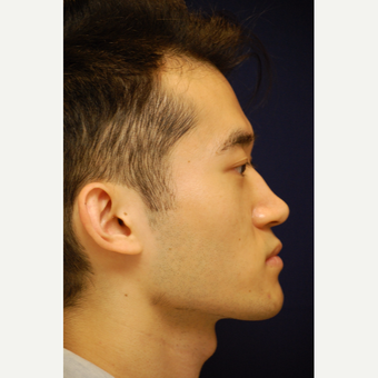 18-24 year old man treated with Rhinoplasty before 3688881
