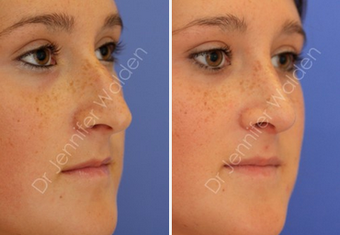 Septorhinoplasty before 1112638