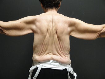 Arm lift before 867504